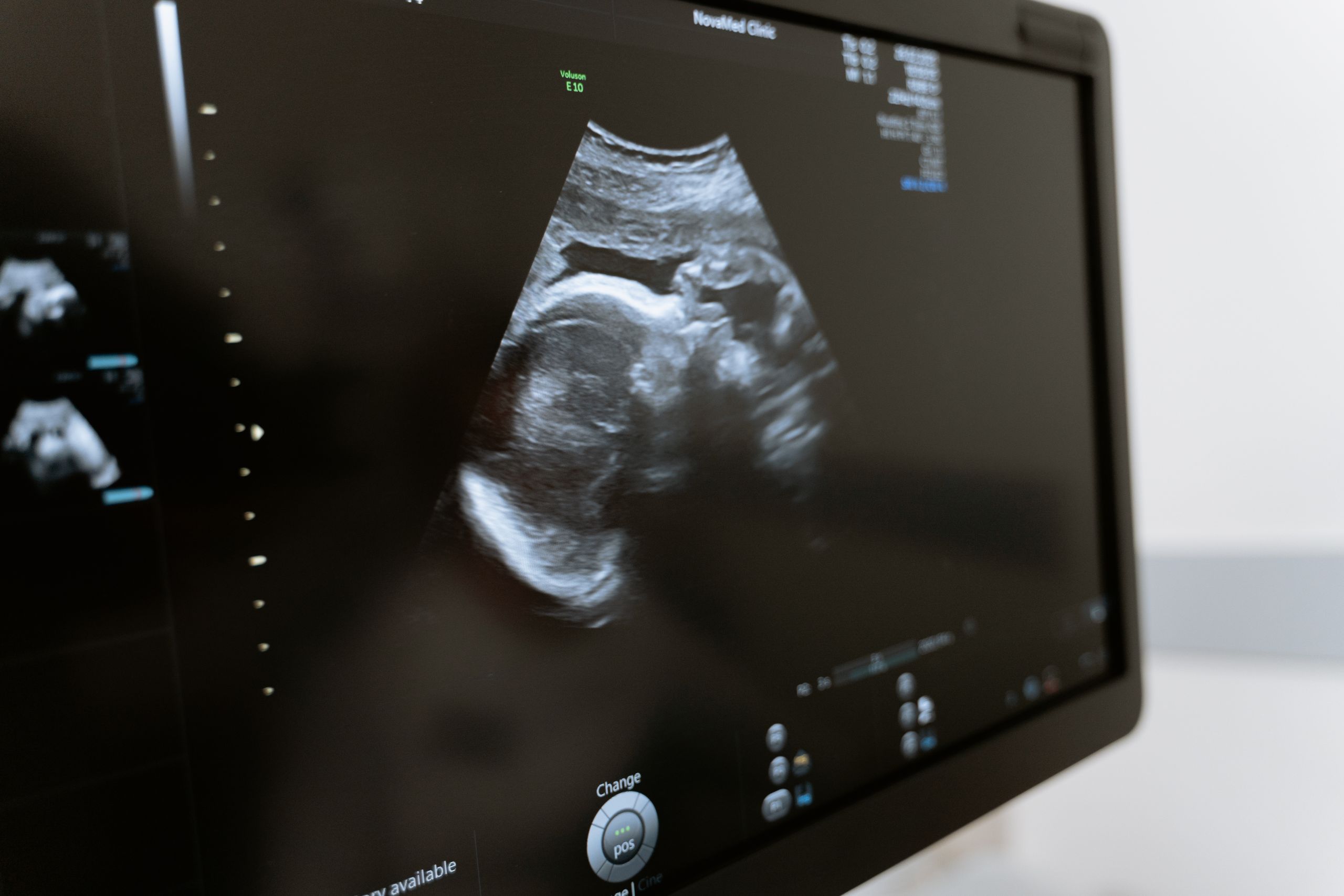 Close-up of an ultrasound showing a fetus on a monitor in a medical clinic.